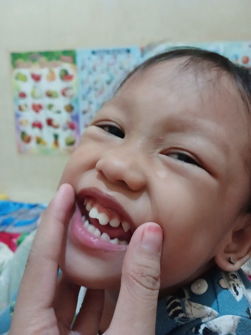 Gigi anak patah karena jatuh