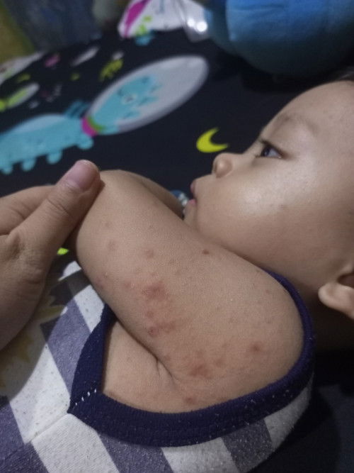 Ini cacar bukan ya ? Kmaren ke puskesmas katanya biang keringat, masa biang keringat kaya gini ?