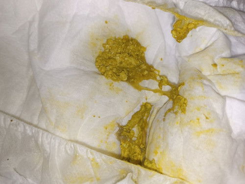 ลักษณะอุจจาระของลูก