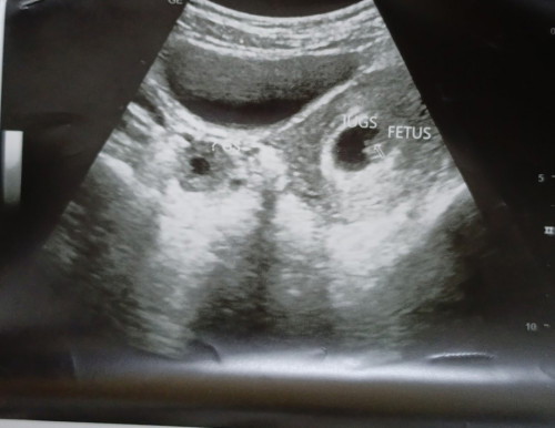 Hi mommies, nk Tanya pasal scan ultrasound. Kenapa bila scan nampak mcm ni ye? Ada x yg pernah jadi