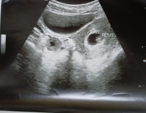 Hi mommies, nk Tanya pasal scan ultrasound. Kenapa bila scan nampak mcm ni ye? Ada x yg pernah  jadi