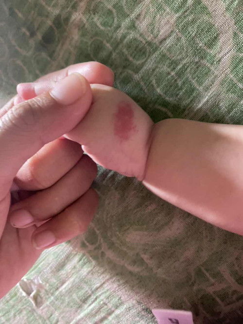 Bé bị nổi đốt đỏ