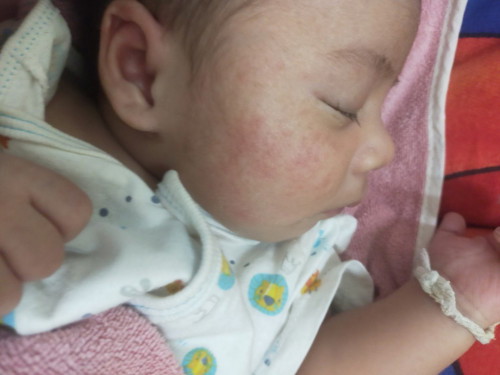 น้องมีผื่นแดง ๆ แบบนี้อยู่ที่แก้มทั้ง2 ข้างเลยค่ะ ทำไงถึงจะหายคะ