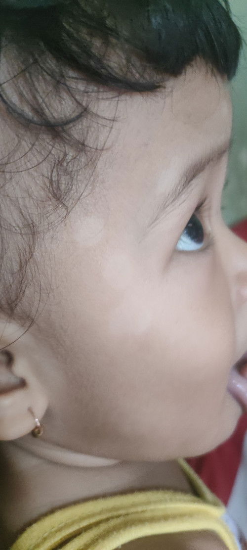 Bercak Putih (Bahasa Jawanya Tratak)