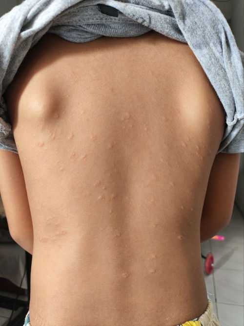 Bercak timbul di punggung anak