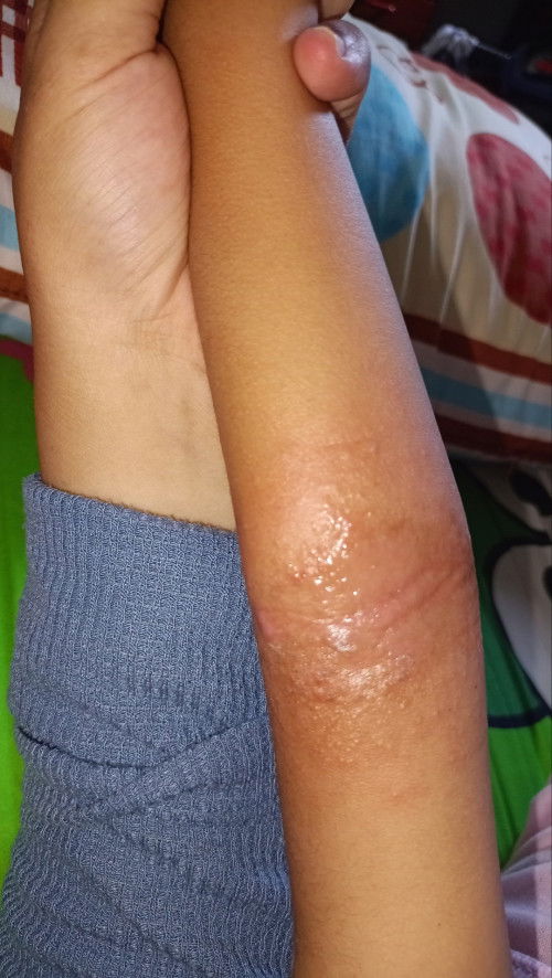 Gatal pada lipatan siku anak