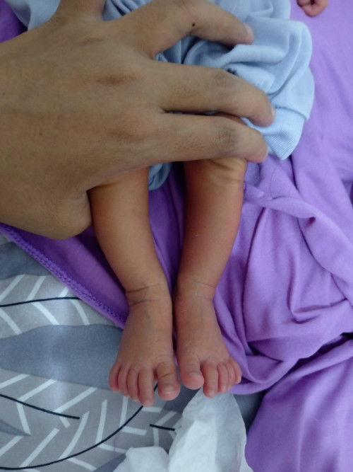 Bentuk kaki newborn