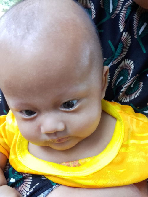 ลูกเป็นจุดๆสีขาวเต็มหน้าบนหัวก็มีไม่ทราบว่าลูกเป็นอะไรคะ?