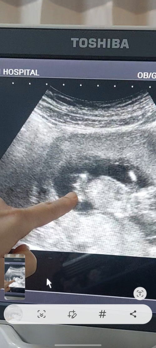 เพศลูก จากการซาวด์ 13 week