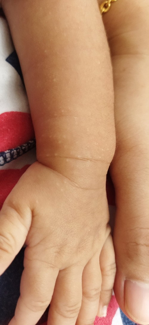 Bintik pada bayi