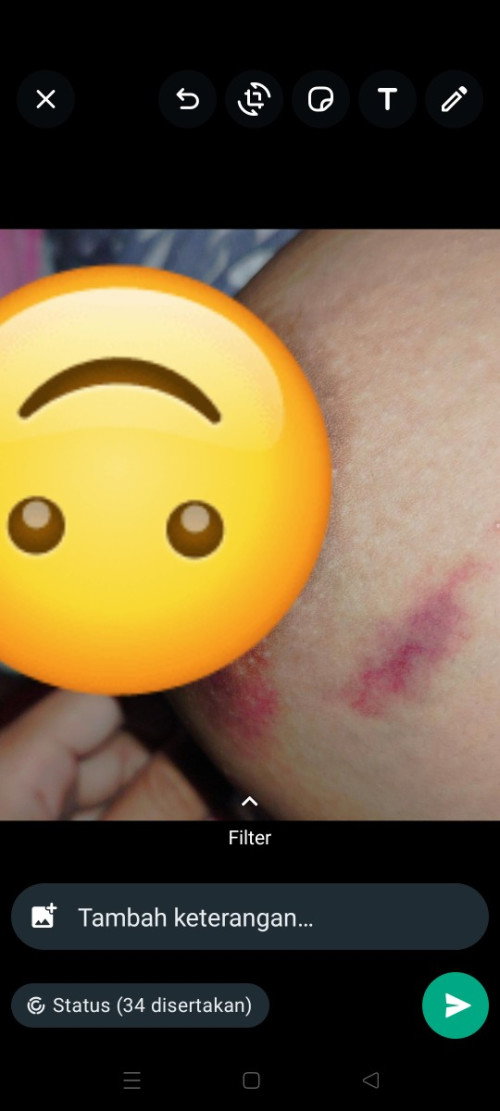 Lebam  pada payudara