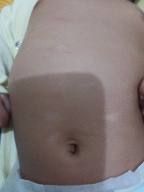 Kulit timbul bercak putih