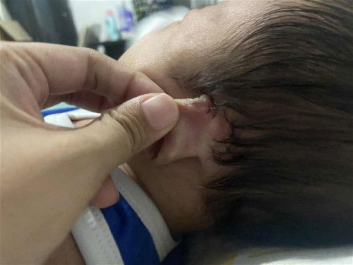 Rash sa likod ng tenga