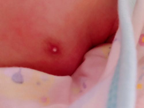 หัวนมของลูกสาวขึ้นสีขาว