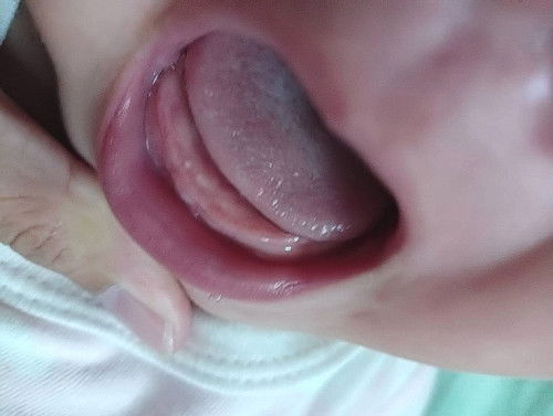 ลักษณะ​ของฟันจะขึ้น