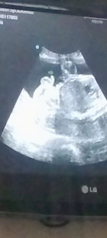 JK laki-laki saat usg 26 week