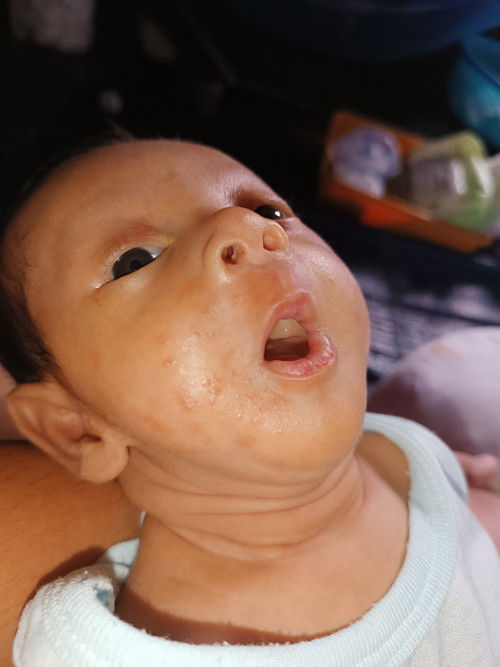 ผื่นขึ้นหน้า