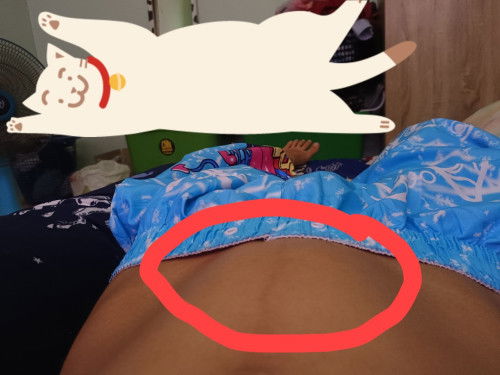 ท้องแข็งนูน