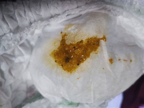 สีอึแบบนี้ปกติไหมคะ