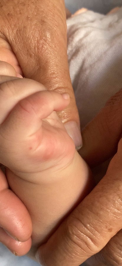 Bé bị sao vậy ạ? Sáng ngủ dậy là thấy vậy, tha dầu k hết ạ