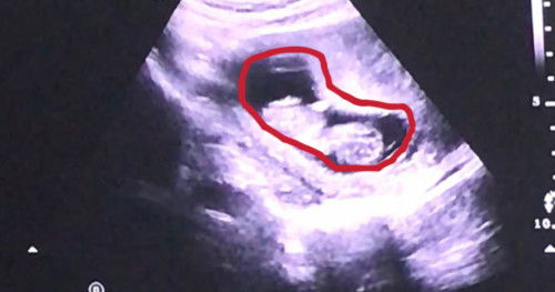 hasil usg 11 week , bun mau tanya ..