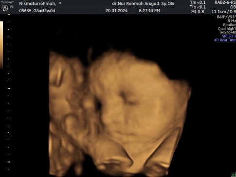 HPL MARET 32 WEEKS BABY GIRL🩷