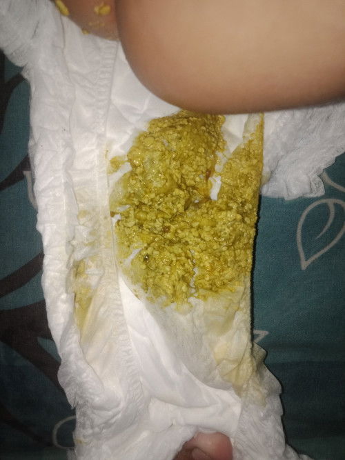 Bunda ini diare bukan ya bunda