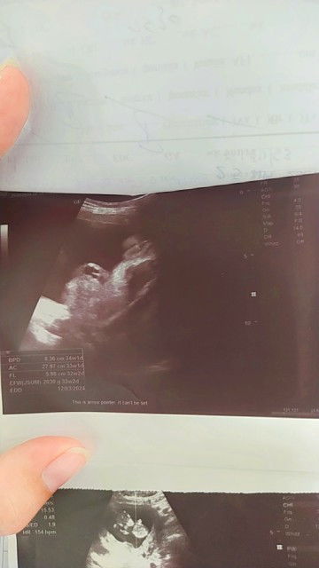 แม่ๆค่ะดูให้หน่อยค่ะ หมอเขาเขียนผิดไหมในใบซาวด์หมอเขียน33W อายุครรภ์จริงๆของเรา34Wพอดีค่ะวันนี้