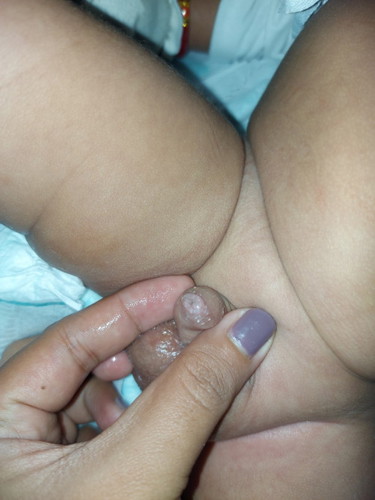 White discharge sa 3 months old baby boy.