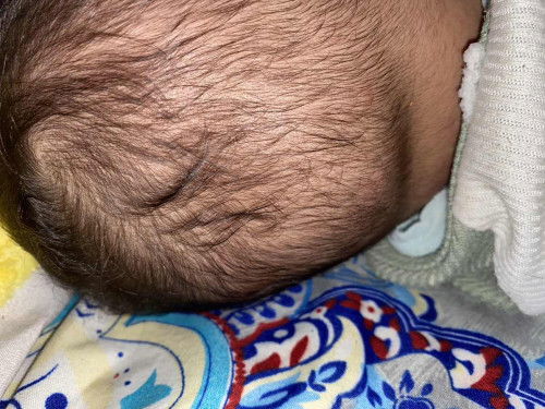 Ada benjolan pada baby 6 bulan