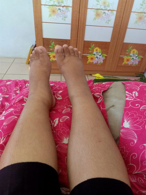Kaki bengkak bahaya kah?