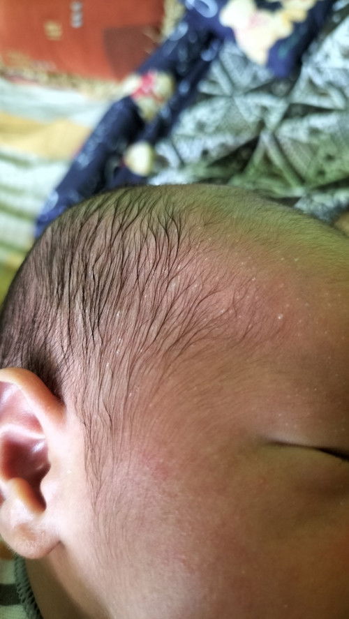 Bintik berair newborn