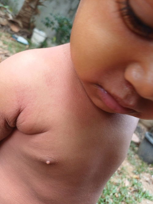 ผื่นคัน เเดง