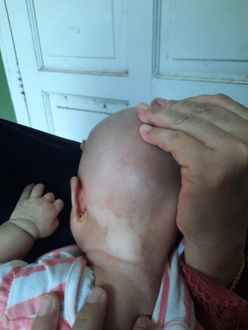 Tanda putih pada kulit bayi umur 2 bulan