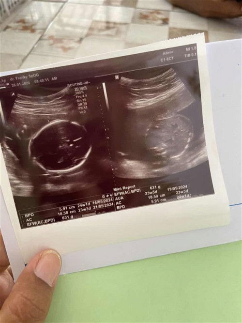 PLASENTA PREVIA. NUTUP JALAN LAHIR 24W. Moms mau tanya ada kemungkinan bisa geser gak?