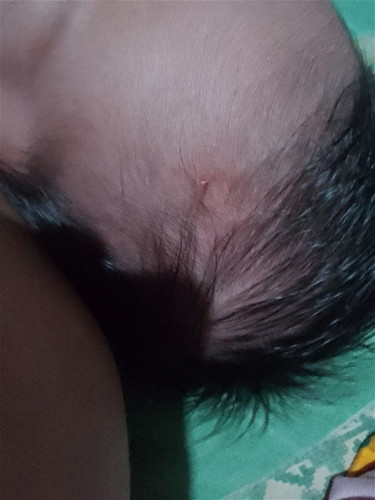 Nasugatan ulo ni baby