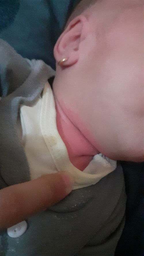 obat buat ruam leher ini apa yah