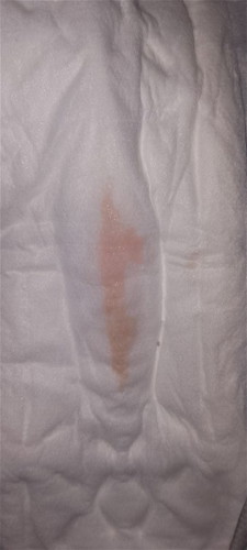 Normal ba sa buntis pag umubo may dugo lumaba 15weeks pregnant po ko sana masagot Tanong ko tnx po