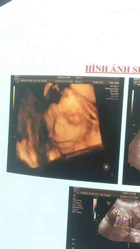 82 kiếp nạn sinh con mọi người ơi !