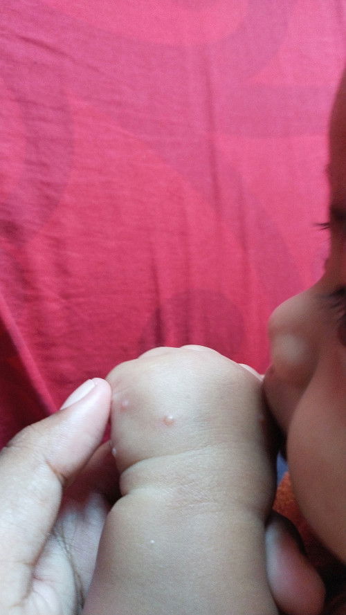 Bun anak aku tiba tiba ada bintik" Berair gitu, kira kira gara" Apa ya, terus cara penanganan nya