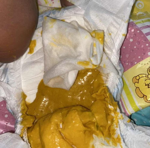 Maaf tekstur pup seperti ini apakah aman, bayi 1 bulan 10 hari