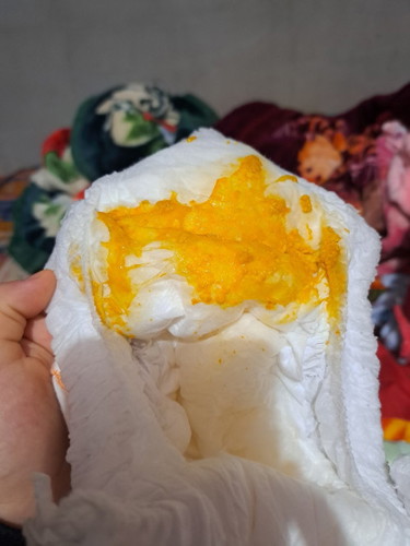 อุจจาระมีมูกปนเเบบนี้ท้องร่วงรึเปล่า