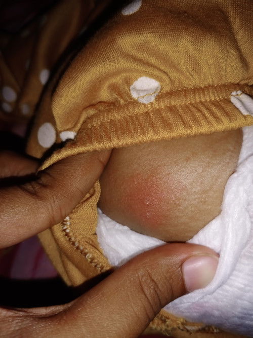 Jenis penyakit gatal