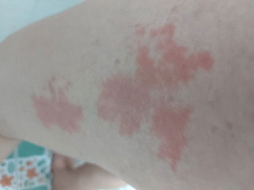 มีใครเป็นบ้างค่ะ