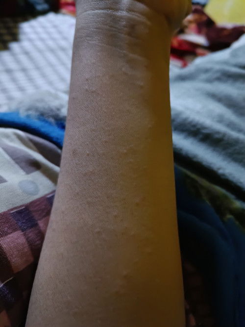 Bintik2 merah dikulit tidak demam