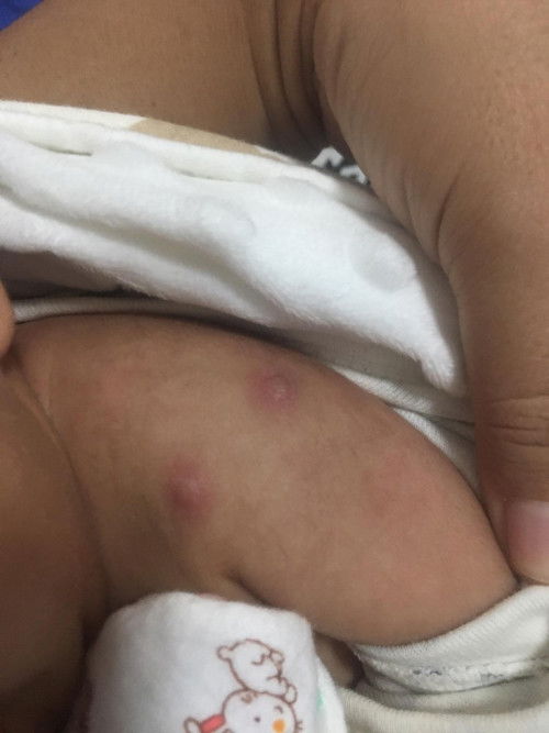 ผูกฝีที่แขนเด็กแรกเกิด