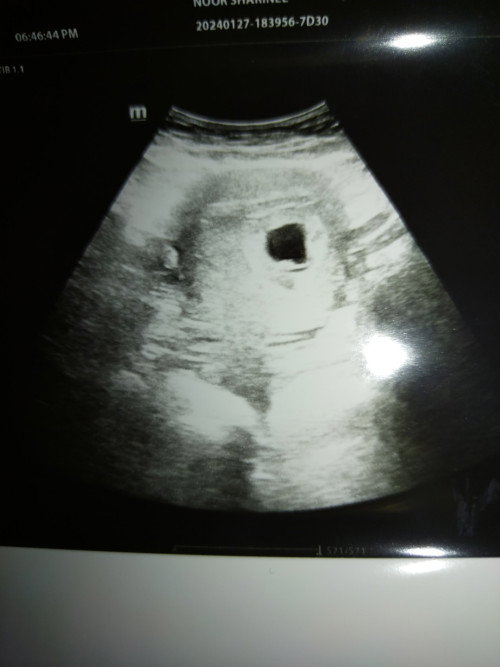 9weeks Adakah kandungan menjadi ?