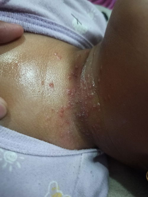 Kemerahan dilipatan leher