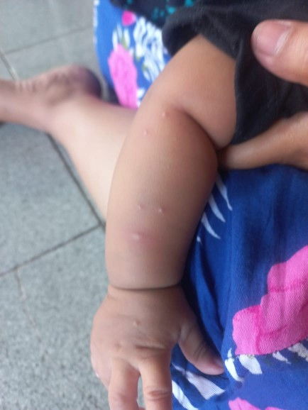 Bintik2 dilengan anak