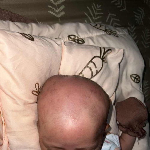 Benjolan dikepala bayi